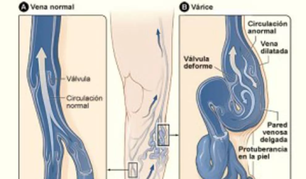 Varices